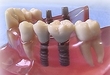 専門医が解説！歯茎を切らないインプラント＝フラップレス手術とは？＜歯科　インプラント＞