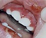 ヘルペス性歯肉口内炎と普通の口内炎の違いをご存じですか？＜茨城県/土浦市/歯科・口腔外科＞
