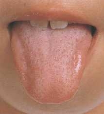 ＜歯科医師が解説＞なかなか治らないベロのヒリヒリは口内炎？舌痛症は何科を受診？